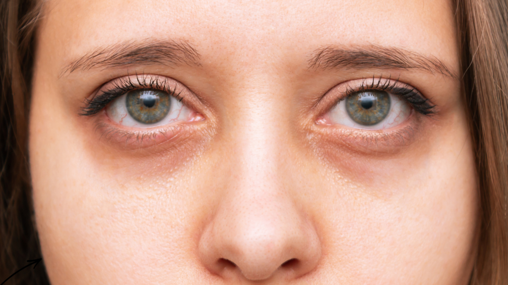 Woman with visible dark circles under her eyes